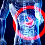 How to Manage Hernia